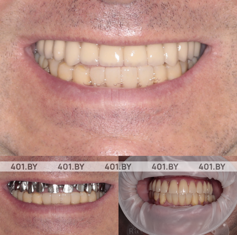 Полное восстановление верхнего зубного ряда по протоколу All-on-6. До